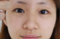 在四川大学华西整形医院做的双眼皮手术，让我摆脱了20多年的单眼皮状态