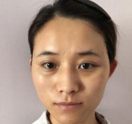 欧洲之星的除皱果让我变美，重回女神行列