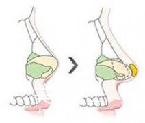 都说怕整形出事 怎么看到我在宁波静港做的鼻子都立马安排上了呢?