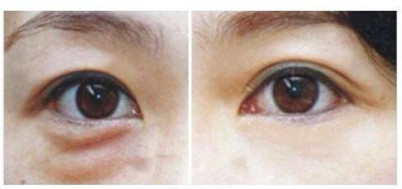 杭州较专业去眼袋医院推荐