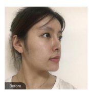 在成都华美进行的假体隆鼻，让我得到彻底的改变