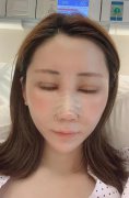 几万块做的自体肋软骨隆鼻果超赞，毫不后悔