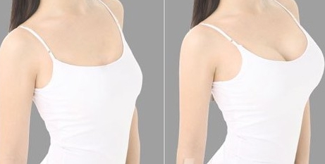 吴建明医生做隆胸手术技术好吗？案例果图分享