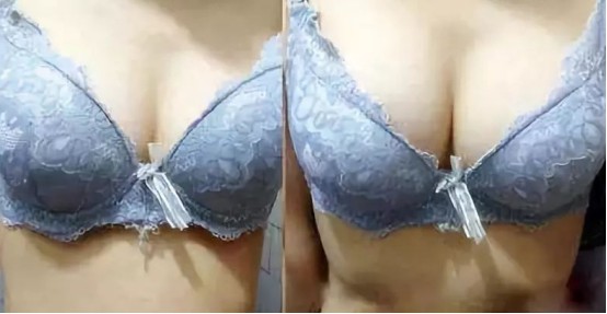 吴建明医生做隆胸手术技术好吗？案例果图分享