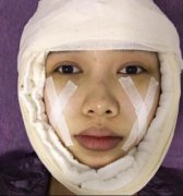 广州和谐医院可以做磨骨手术吗？术后90天的恢复情况