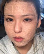 深圳和平医院面部脂肪填充果？附真人前后对比图