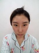 王斌仁和原生美眼案例果如何？案例前后对比图