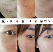 光子嫩肤哪家医院好？案例有吗？