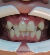 在新疆整形医院徐文飞做的牙齿矫正让我拥有了自信，附前后对比图