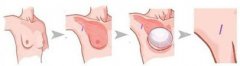假体隆胸多久可以泡温泉?恢复以后会不会留下痕迹?案例分享