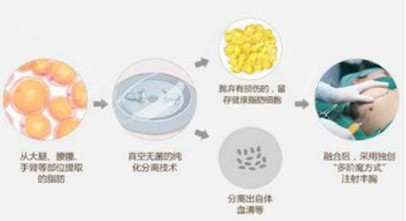 隆胸找李春财，李春财医生在整形领域有怎样的技术实力?