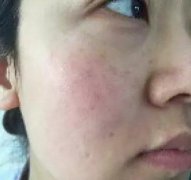 光子嫩肤果好吗？2例案例前后对比图