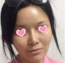 整形专家杨斌技术如何？整形专家杨斌案例分享