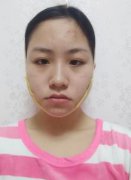 穆雄铮整形医生擅长下颌角磨骨手术吗？附前后对比图