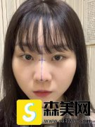 柳春明的驼峰鼻整形案例，附真人隆鼻前后对比照片