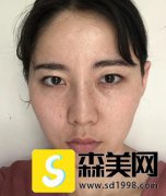 整形医生刘先超所做的眼部手术如何？附术后三个月恢复记录