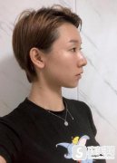 南京市妇幼保健院整形科双眼皮果？附前后对比照片