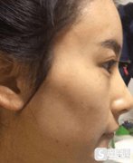 关于润百颜黑金玻尿酸价格如何？在深圳美莱注射了下巴对比图