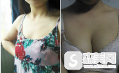 金尚训医生的美胸案例，让我再变傲胸女王！