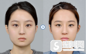 磨骨医生张笑天做的怎么样？磨骨医生张笑天案例分享