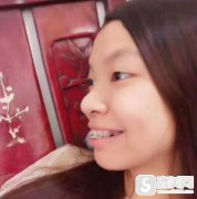 张忠医生矫正牙齿如何？附矫正前后对比图