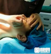 整形医生赵宇的双眼皮手术果？手术前后对比图