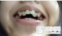 正颌博士刘玥在矫正牙齿中的技术如何？矫正恢复图浏览