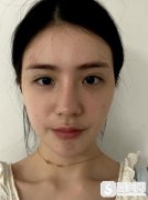 重庆天妃整形医院的面部脂肪填充技术咋样？整形科恢复浏览详情