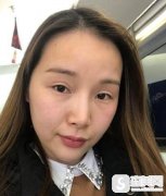 重庆真伊整形可靠，我在这里填充脸颊脂肪果很好