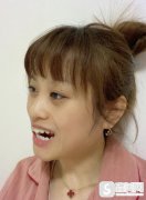 周洋正颌正畸果如何？附一年恢复详情