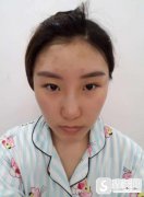 徐州四院埋线双眼皮做的怎么样？整形科90天恢复果