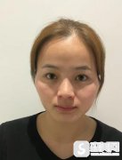 珠海哪个医院打玻尿酸比较好？珠海莱茵注射填充案例对比图