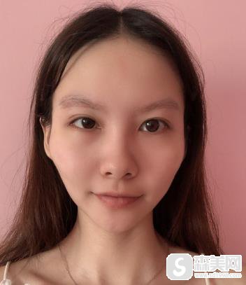 颧骨高太阳凹陷自己怎么改善？上海时光手术前后对比图