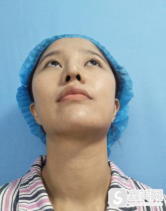 颧骨宽显得脸大怎么办？301医院颧骨案例恢复图