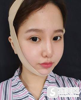 颧骨宽显得脸大怎么办？301医院颧骨案例恢复图