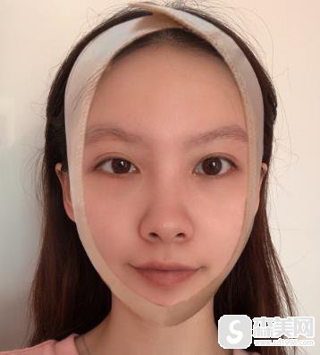 颧骨高太阳凹陷自己怎么改善？上海时光手术前后对比图