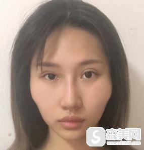 颧弓外扩怎么办？山西省整形科手术前后对比