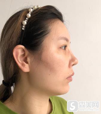 颧弓突出怎么办啊？手术前后对比图