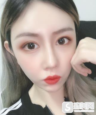 颧弓突出怎么办啊？手术前后对比图