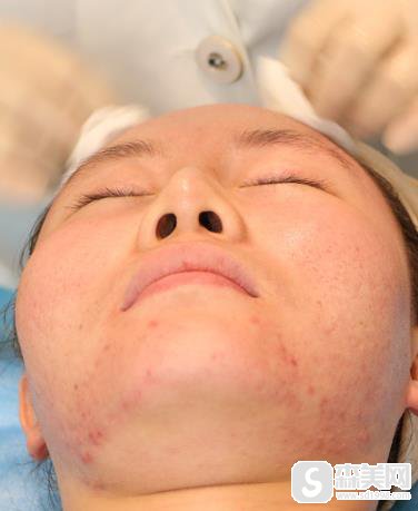 去痘微创案例，盛京医院整形科术后恢复对比
