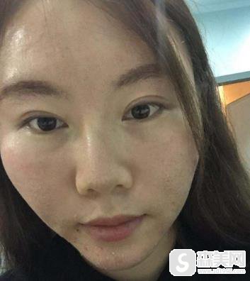 去痘微创案例，盛京医院整形科术后恢复对比