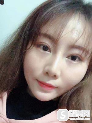 去痘微创案例，盛京医院整形科术后恢复对比