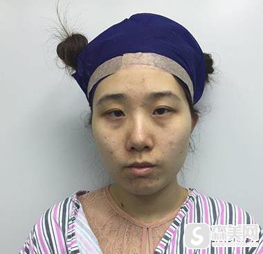 广东美恩顾浩双眼皮整形案例分享，附案例对比图