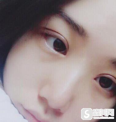 广东美恩顾浩双眼皮整形案例分享，附案例对比图