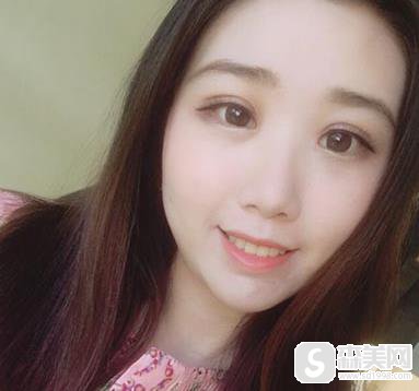 广东美恩顾浩双眼皮整形案例分享，附案例对比图