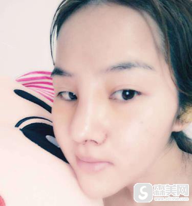 广东美恩的陈宏彬隆鼻做的好吗？90天恢复详情