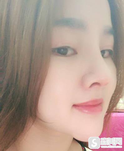 广东美恩的陈宏彬隆鼻做的好吗？90天恢复详情