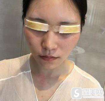 成都悦好整形眼部手术怎么样？开眼角前后对比