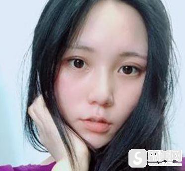 成都悦好整形眼部手术怎么样？开眼角前后对比