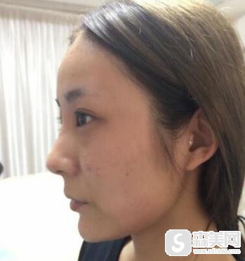 伊美尔整容医院好不好?附真实案例+果对比图